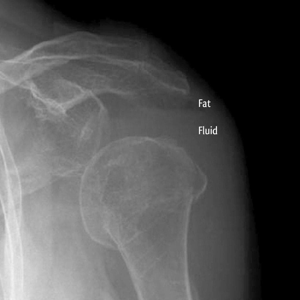 Lipohemarthrosis - shoulder