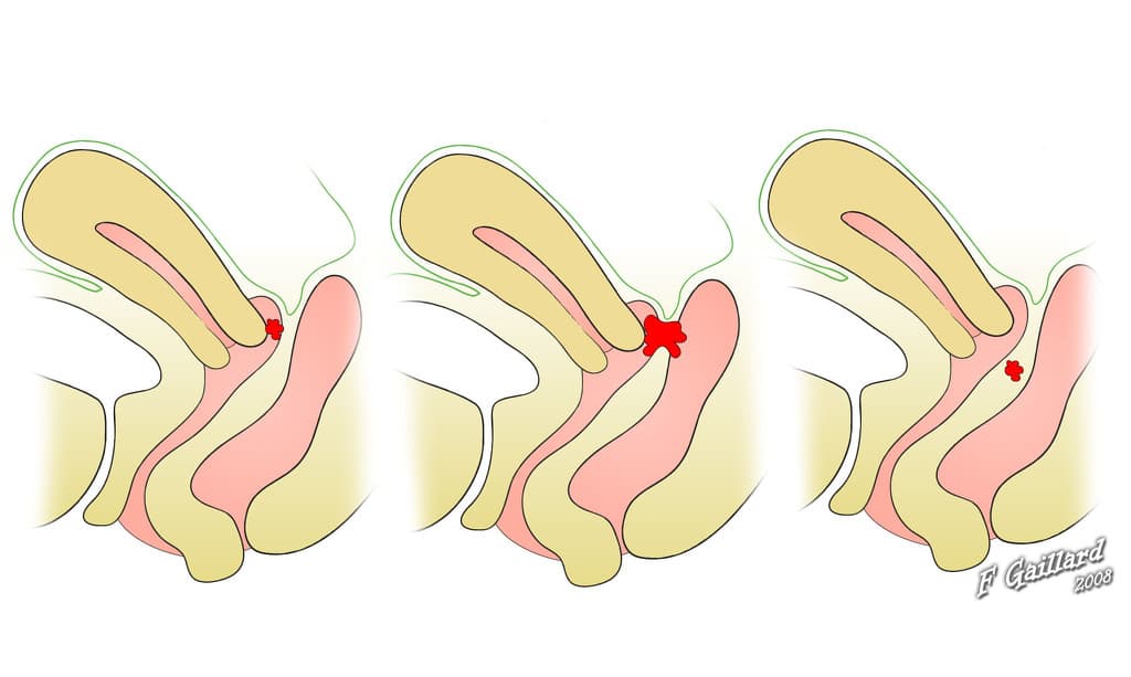 Endometriosis (diagrams)
