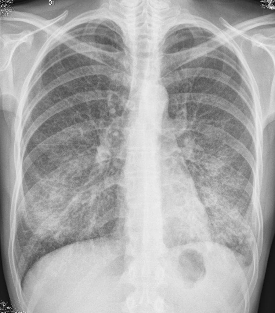 Primary Atypical Pneumonia (Viêm phổi nguyên phát dạng không điển hình)