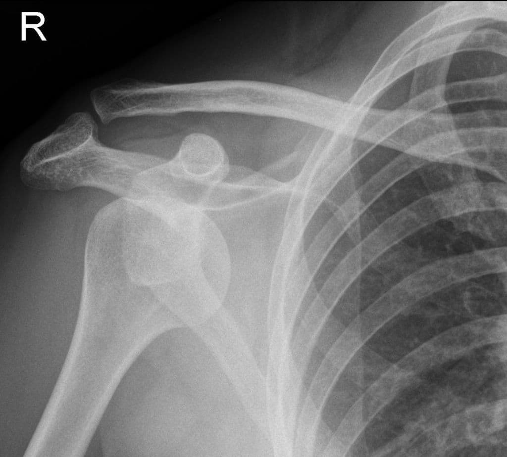 Anterior shoulder dislocation