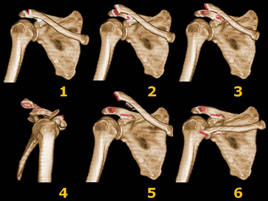 Rockwood Classification System of Acromioclavicular Joint Injuries (Hệ thống phân loại Rockwood các tổn thương khớp cùng đòn)