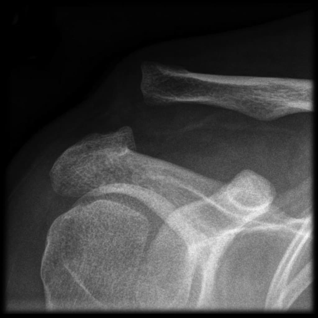 Acromioclavicular Joint Injury with Superior Clavicle Displacement (Chấn thương khớp cùng đòn)