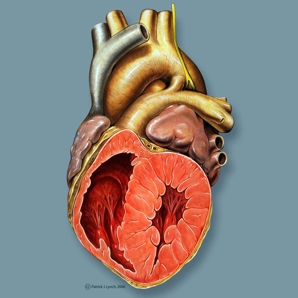 Patent ductus arteriosus