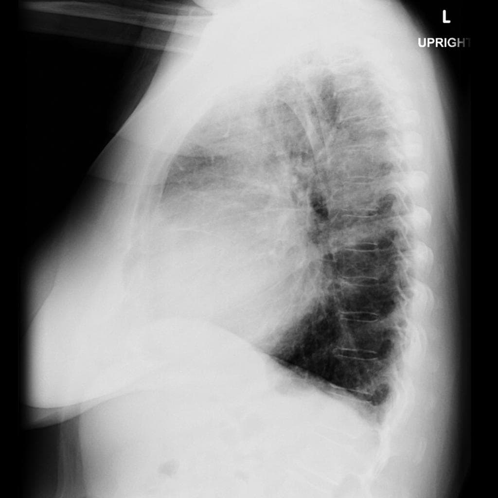 Atrial myxoma