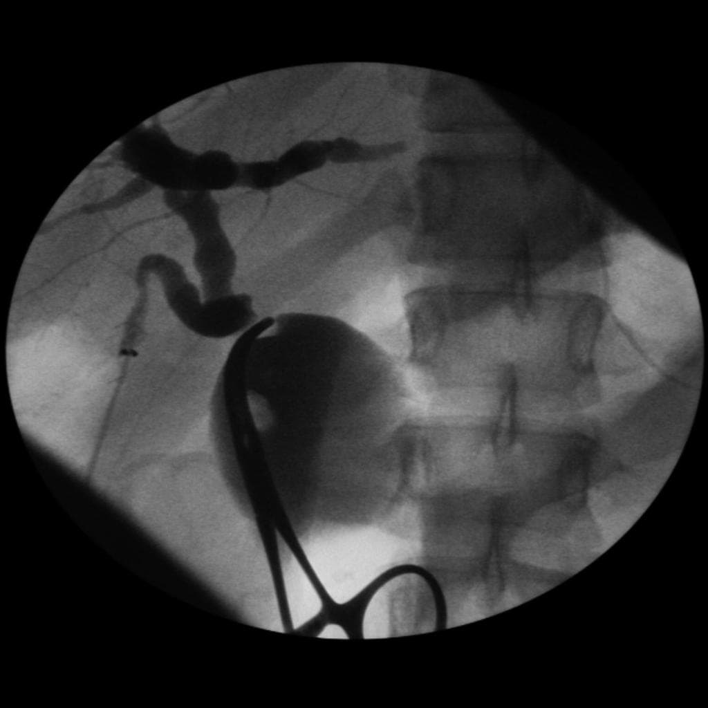 Choledochocoele (U nang ống mật chủ type III (Choledochocoele))