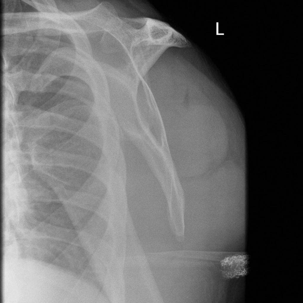 Anterior shoulder dislocation