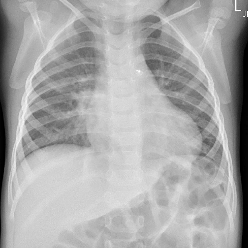 Patent ductus arteriosus closure device