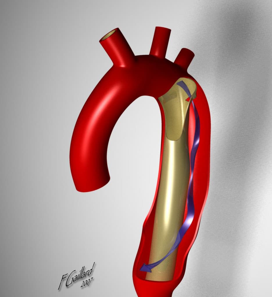 Aortic dissection DeBakey classification (illustration)