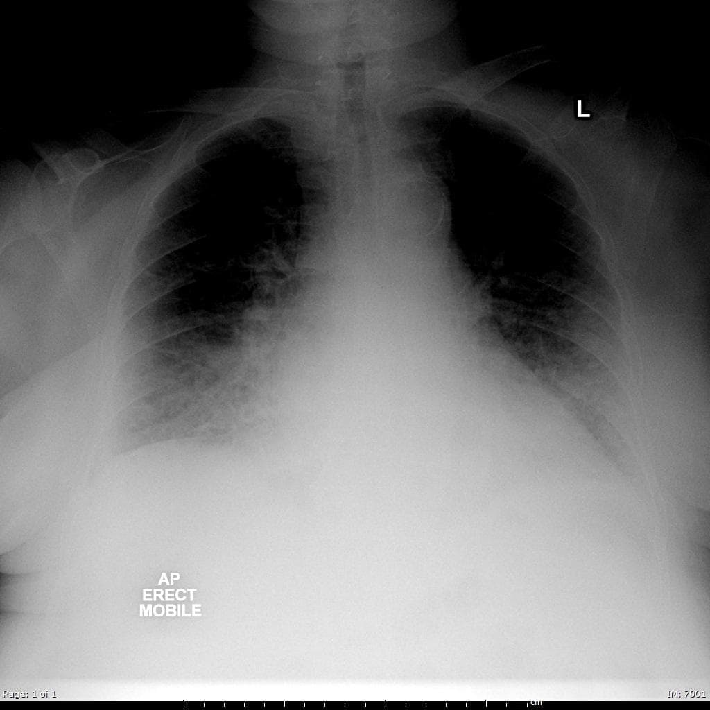 Thoracic aortic dissection: Stanford type A