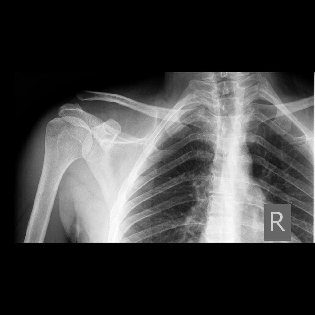 Acromioclavicular Joint Dislocation (Trật khớp cùng đòn)