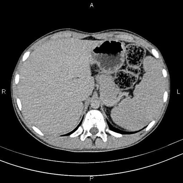 Sarcoma of the renal capsule - pediatric (U ác tính vỏ thận – nhi khoa)