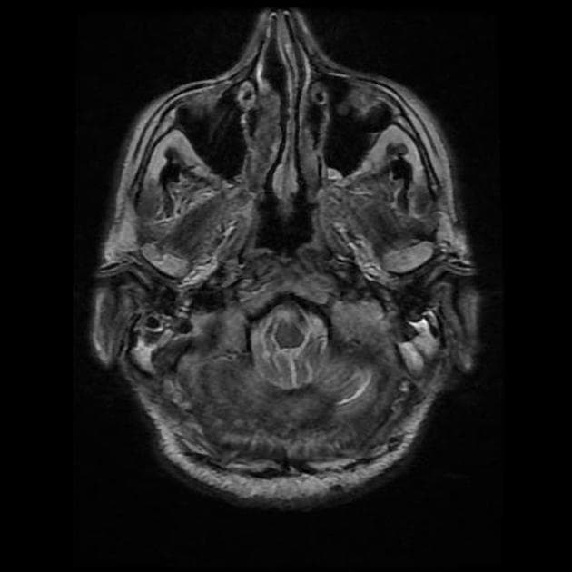 Brain metastasis - small cell lung cancer