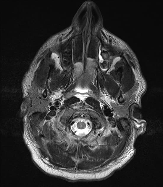 Toxic Leukoencephalopathy (Bệnh não độc chất)