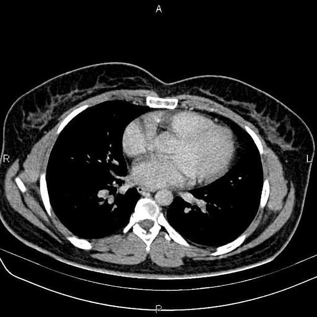Hepatic adenoma - multiple