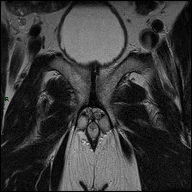 Prostate adenocarcinoma: PIRADS 5