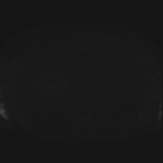 Confluent Hepatic Fibrosis (Xơ gan lan tỏa)