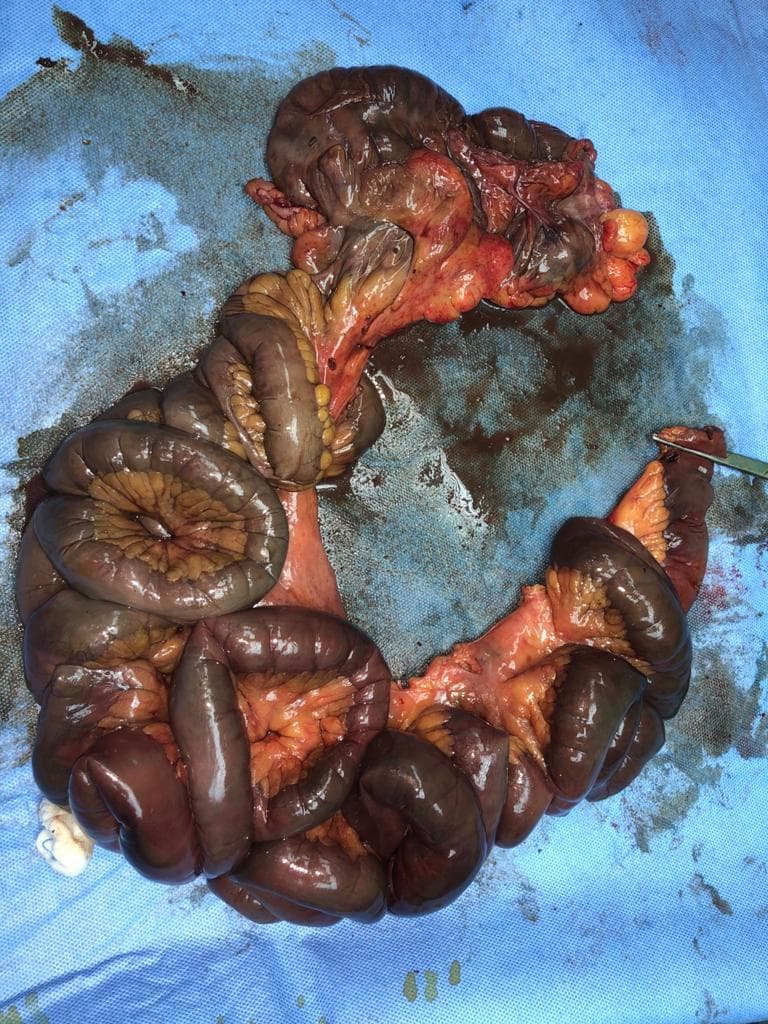 Arterial occlusive mesenteric ischemia