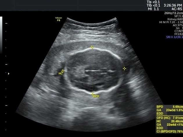 Asymmetrical Intrauterine Growth Restriction with Fetal Distress (Hạn chế tăng trưởng trong tử cung bất đối xứng kèm suy thai)