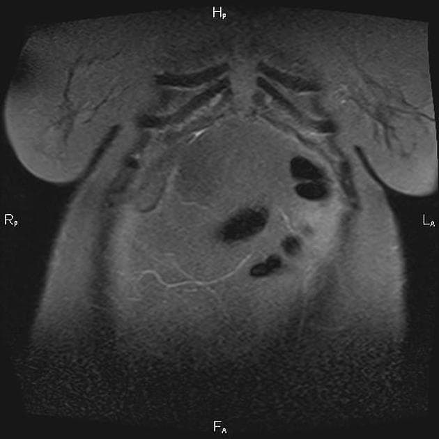 Choledochal Cyst - Type Ia (Nang ống mật chủ - type Ia)