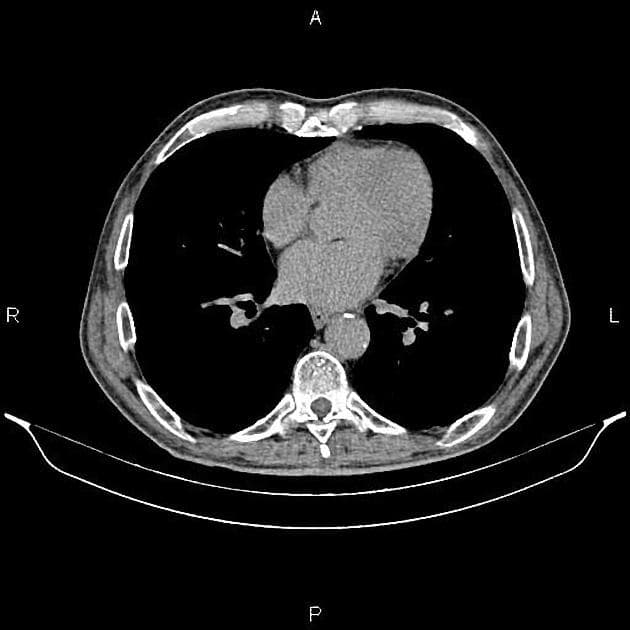 Urinary Bladder Cancer (Ung thư bàng quang)
