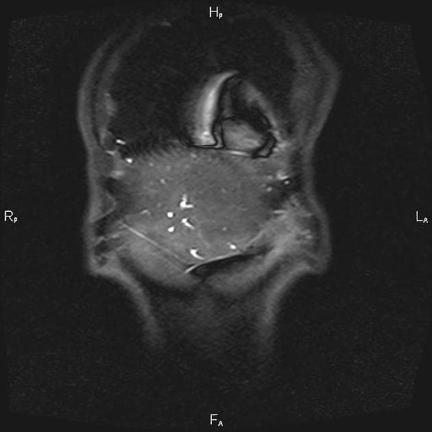 Cholangiocarcinoma (Ung thư tế bào ống mật (Cholangiocarcinoma))