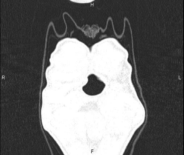 Air Bronchogram in Pneumonia (Hiện tượng phế quản khí trong viêm phổi)