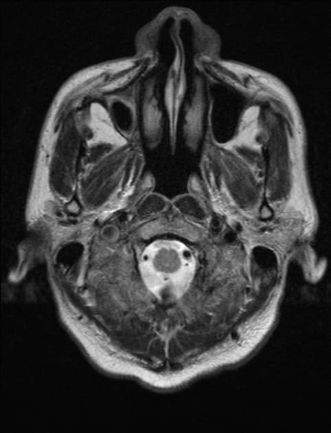 Brain Abscess with Ventriculitis (Áp xe não kèm viêm não thất)