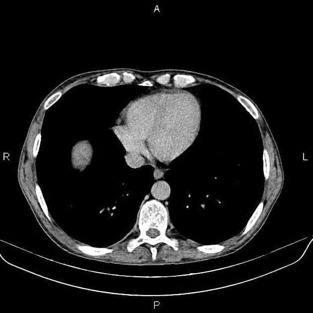 Comb sign in active Crohn disease