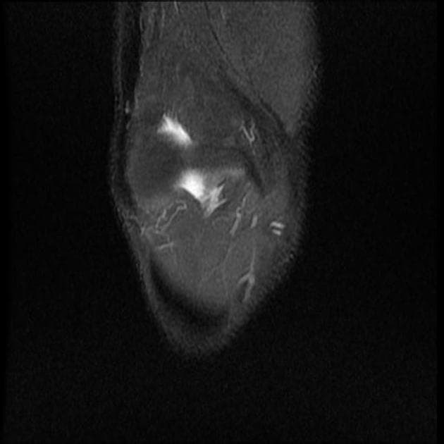 Lateral Meniscus Bucket Handle Tear (Xé dạng xô hình thùng ở sụn chêm bên)