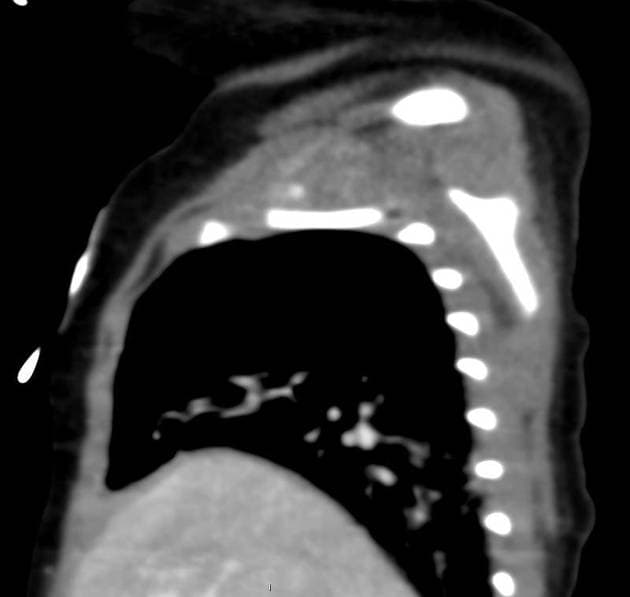 Double outlet right ventricle