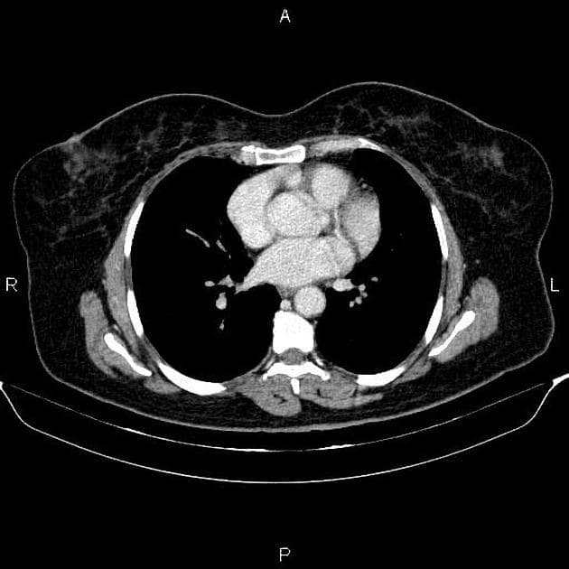 Multifocal urothelial cell carcinoma (Ung thư biểu mô đường niệu đa ổ)