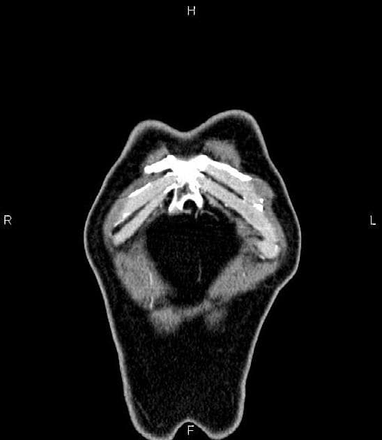 Pancreatic Adenocarcinoma with Vascular Encasement (Ung thư biểu mô tuyến tụy)