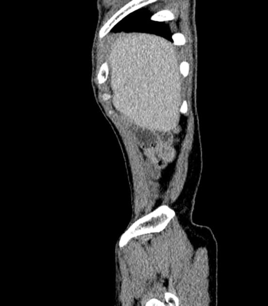Ileocecal tuberculosis