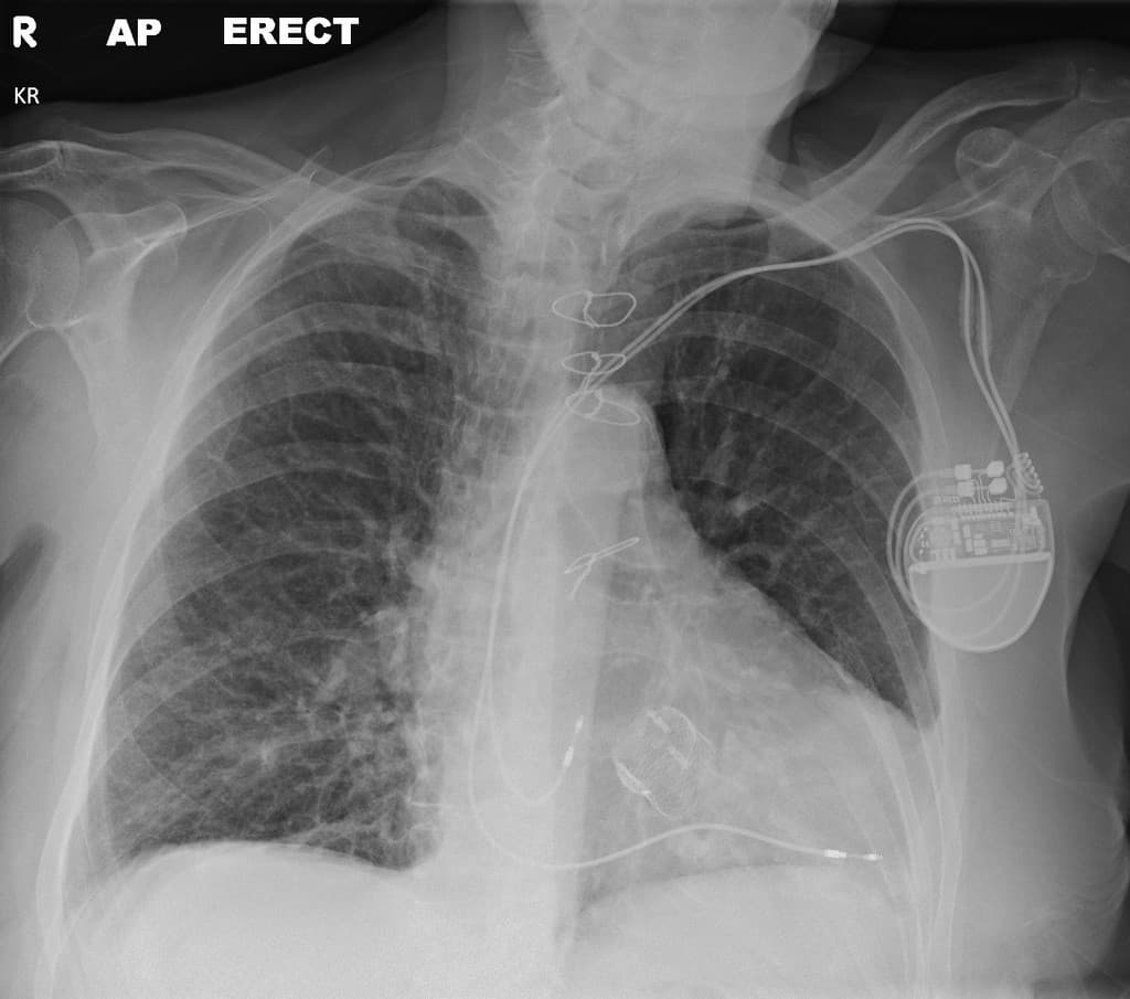 Transcatheter aortic valve implant