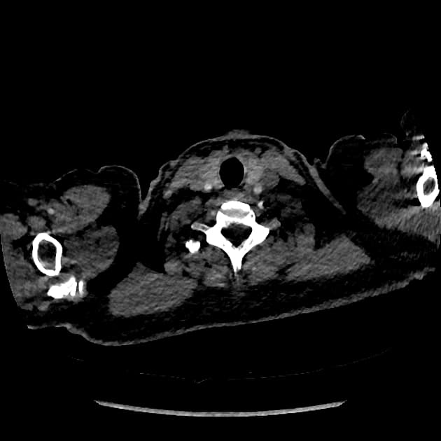 Normal dual-energy chest CT angiography with pulmonary embolism protocol