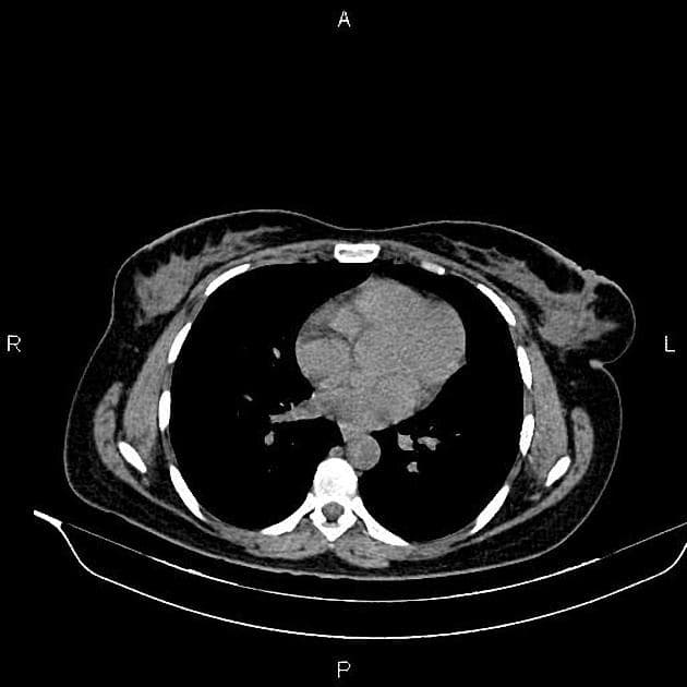 Renal Angiomyolipoma (U mỡ cơ mạch thận)