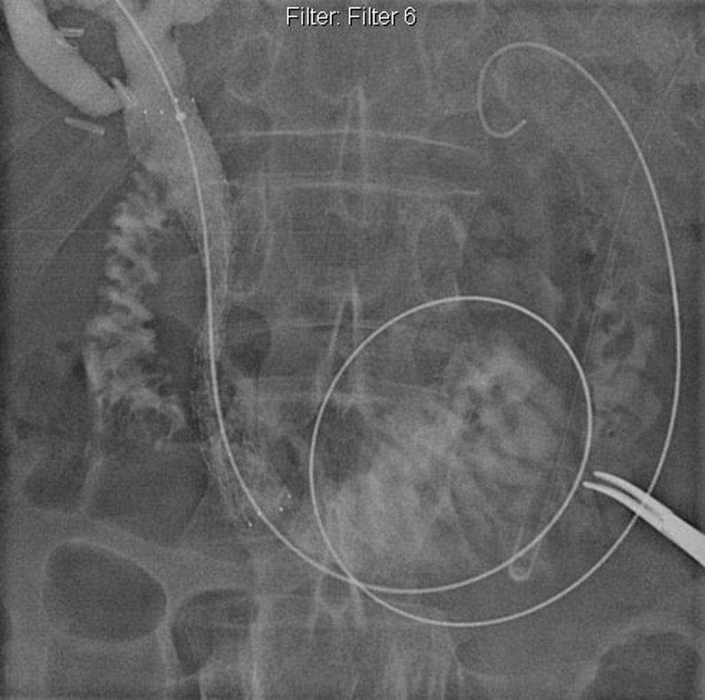 Biliary Stenting for Lower Common Bile Duct Cholangiocarcinoma (Đặt stent đường mật – ung thư biểu mô ống mật chủ đoạn dưới)