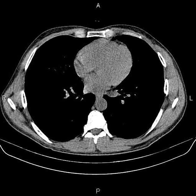 Hepatic Carcinoid (Ung thư tuyến nội tiết gan)