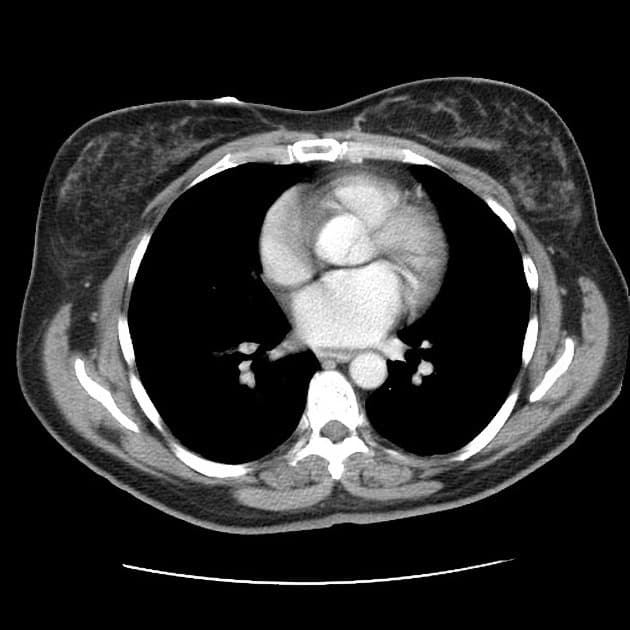 Small bowel angioedema (ACE-inhibitor related)