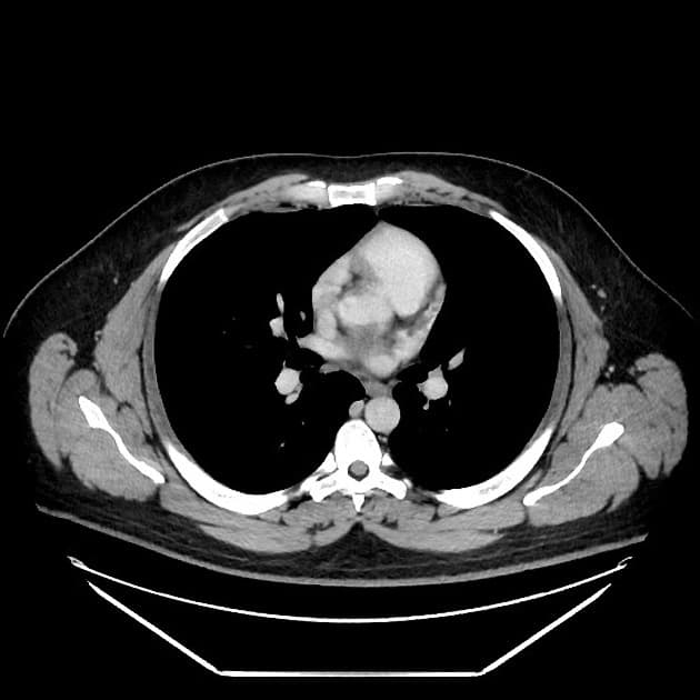 Fistulizing Crohn disease