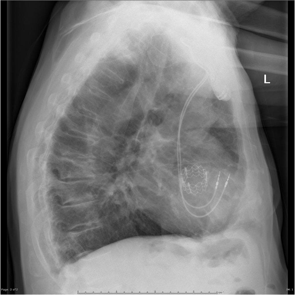 Transcatheter aortic valve replacement