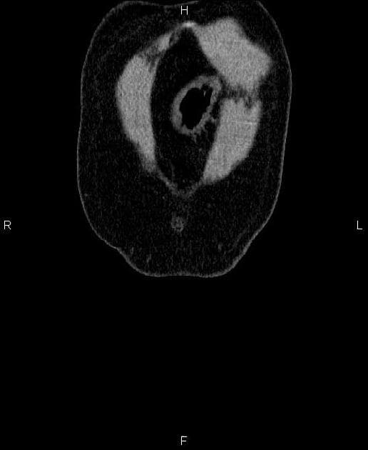 Renal Angiomyolipoma (U cơ mỡ mạch thận)