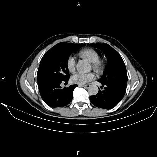 Renal Cell Carcinoma in Horseshoe Kidney (Ung thư biểu mô tế bào thận trên thận móng ngựa)
