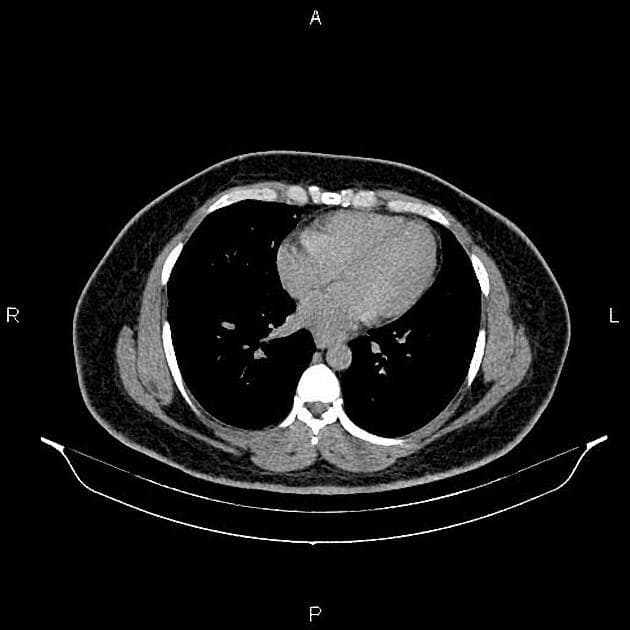Mesenteric ischemia