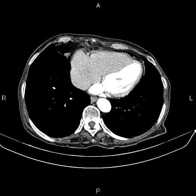 Metastatic Pancreatic Cancer (Ung thư tụy di căn)