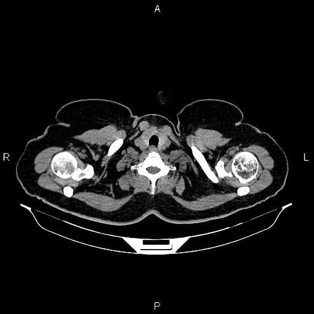 Renal angiomyolipoma (U lành tính mạch cơ mỡ thận)