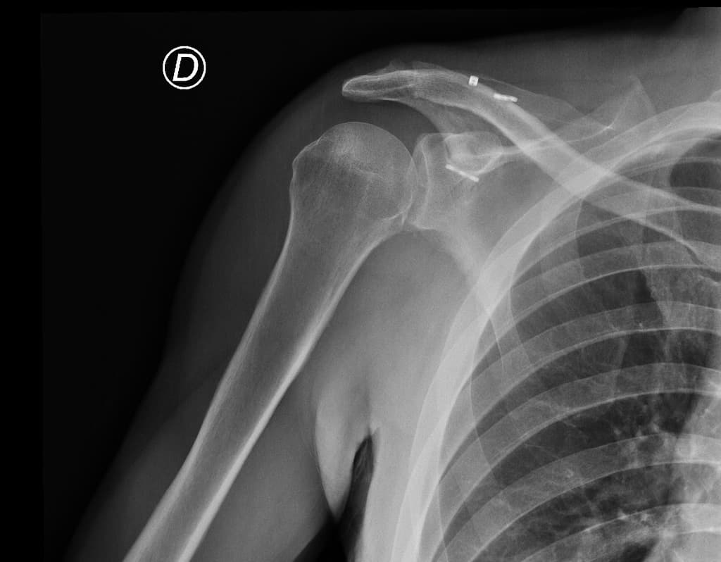 Acromioclavicular Joint Dislocation with Tightrope Fixation (Trật khớp cùng đòn với cố định bằng Tightrope)