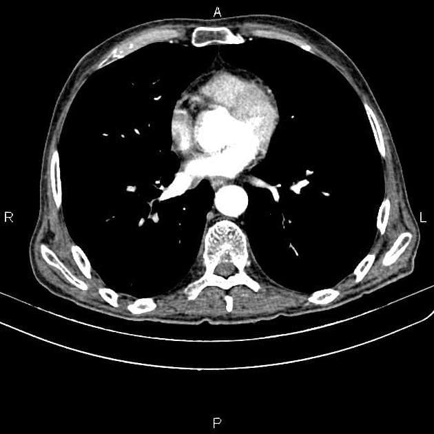 Pancreatic Cancer with Vascular Invasion and Hepatic Metastases (Ung thư tụy)