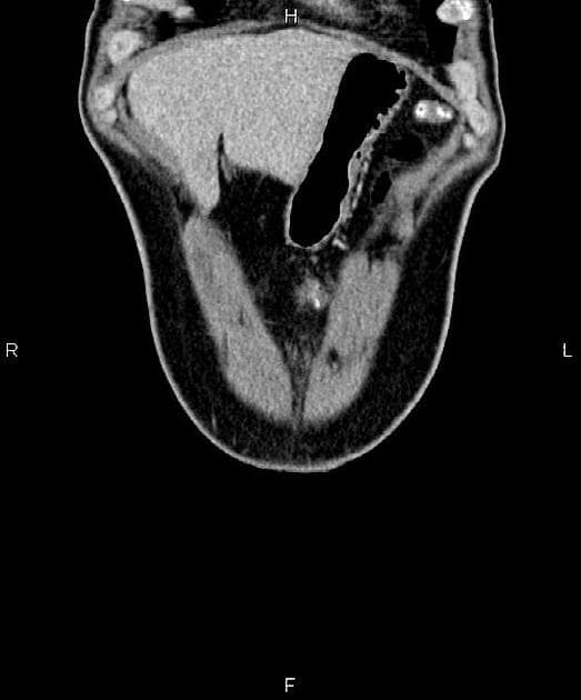 Pancreatic Adenocarcinoma with Superior Mesenteric Vessel Involvement (Ung thư biểu mô tuyến tụy)
