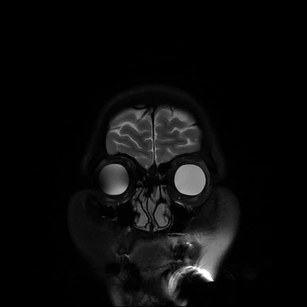 Chordoid glioma of third ventricle